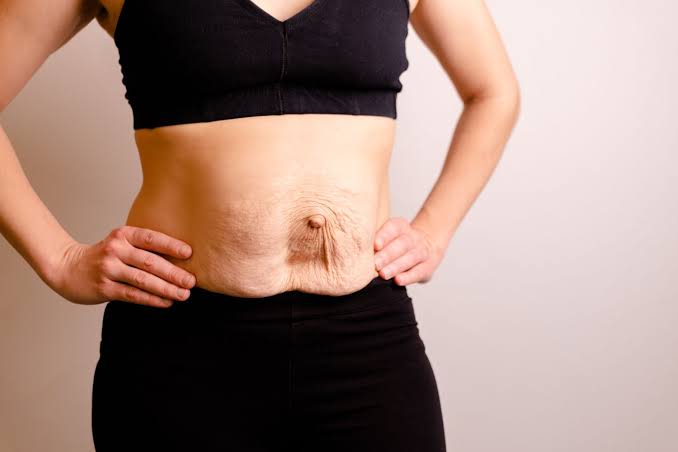 Is Surgery Really the Only Way to Repair Diastasis Recti Runnymede?